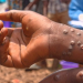 Ghana records 20 new Mpox cases, pushing  total to 302